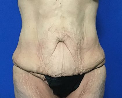 Abdominoplasty Before & After Patient #2033