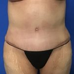 Abdominoplasty Before & After Patient #2033