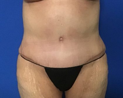 Abdominoplasty Before & After Patient #2033