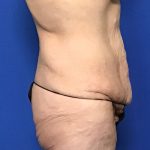 Abdominoplasty Before & After Patient #2033