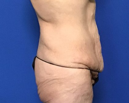 Abdominoplasty Before & After Patient #2033