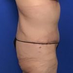 Abdominoplasty Before & After Patient #2033