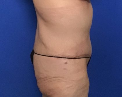 Abdominoplasty Before & After Patient #2033