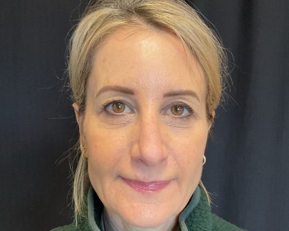 Blepharoplasty Before & After Patient #2035