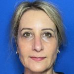 Blepharoplasty Before & After Patient #2035