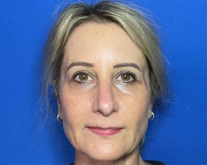 Blepharoplasty Before & After Patient #2035