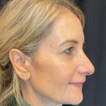 Blepharoplasty Before & After Patient #2035