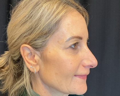 Blepharoplasty Before & After Patient #2035