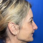 Blepharoplasty Before & After Patient #2035