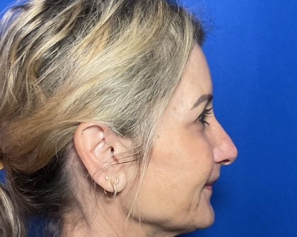 Blepharoplasty Before & After Patient #2035