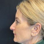 Blepharoplasty Before & After Patient #2035
