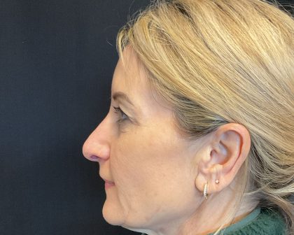 Blepharoplasty Before & After Patient #2035