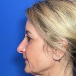 Blepharoplasty Before & After Patient #2035