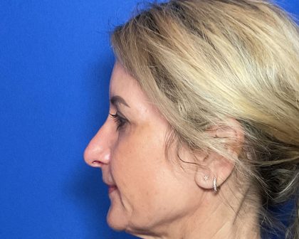 Blepharoplasty Before & After Patient #2035