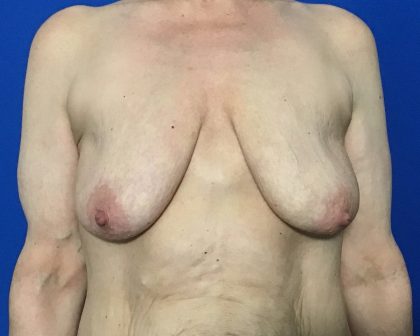 Breast Lift with Augmentation Before & After Patient #2038