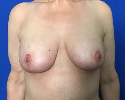 Breast Lift with Augmentation Before & After Patient #2038