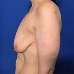 Breast Lift with Augmentation Before & After Patient #2038