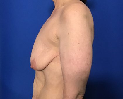 Breast Lift with Augmentation Before & After Patient #2038