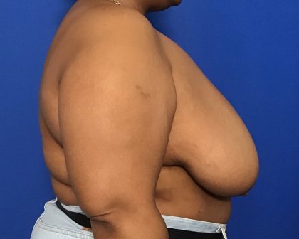 Breast Reduction Before & After Patient #2039