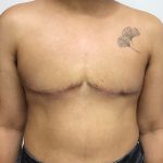 Chest Masculinization Before & After Patient #2042