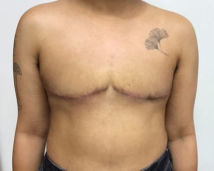 Chest Masculinization Before & After Patient #2042