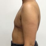Chest Masculinization Before & After Patient #2042