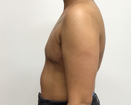 Chest Masculinization Before & After Patient #2042