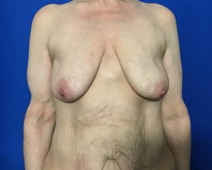 Massive Weight Loss Before & After Patient #2047