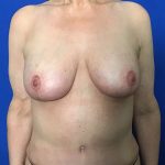 Massive Weight Loss Before & After Patient #2047