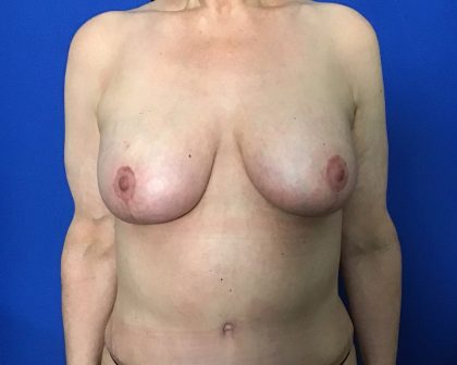 Massive Weight Loss Before & After Patient #2047