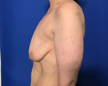 Massive Weight Loss Before & After Patient #2047