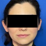 Otoplasty Before & After Patient #2049