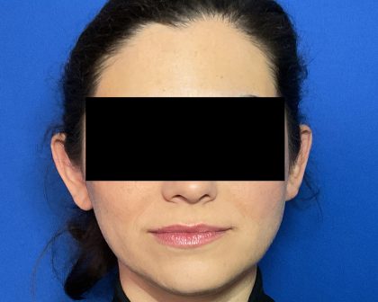Otoplasty Before & After Patient #2049