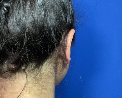 Otoplasty Before & After Patient #2049