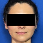 Otoplasty Before & After Patient #2049
