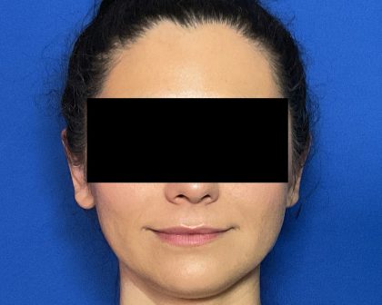 Otoplasty Before & After Patient #2049