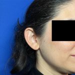 Otoplasty Before & After Patient #2049