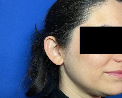 Otoplasty Before & After Patient #2049