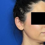 Otoplasty Before & After Patient #2049