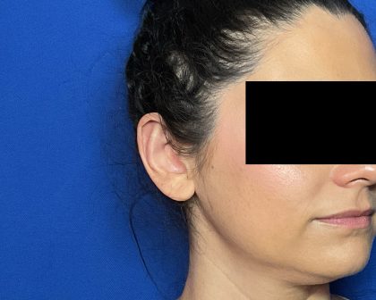 Otoplasty Before & After Patient #2049