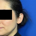 Otoplasty Before & After Patient #2049