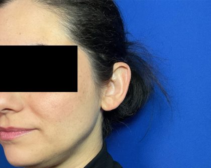 Otoplasty Before & After Patient #2049