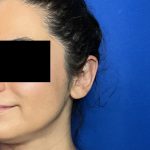 Otoplasty Before & After Patient #2049