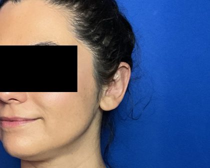 Otoplasty Before & After Patient #2049