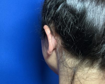 Otoplasty Before & After Patient #2049