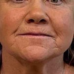 Laser Resurfacing Before & After Patient #2045