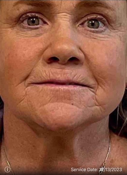 Laser Resurfacing Before & After Patient #2045