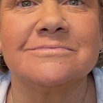 Laser Resurfacing Before & After Patient #2045
