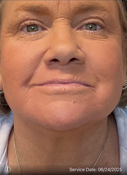 Laser Resurfacing Before & After Patient #2045