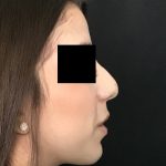 Rhinoplasty Before & After Patient #2050